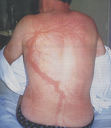 Lightning Strike on Human